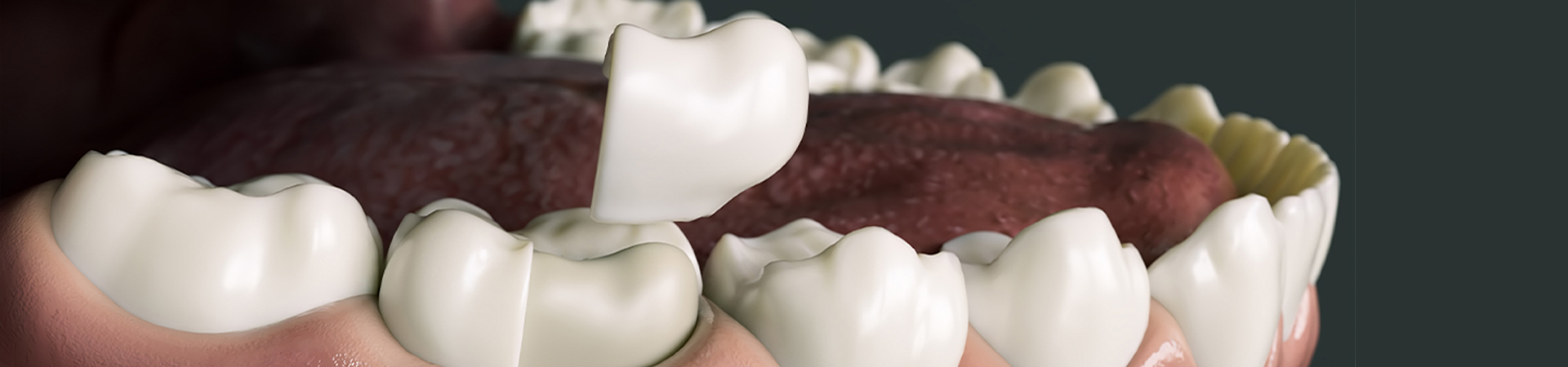 An assortment of dental crowns and caps displayed on a blue surface, highlighting their different designs and materials at New Smile Dentistry.