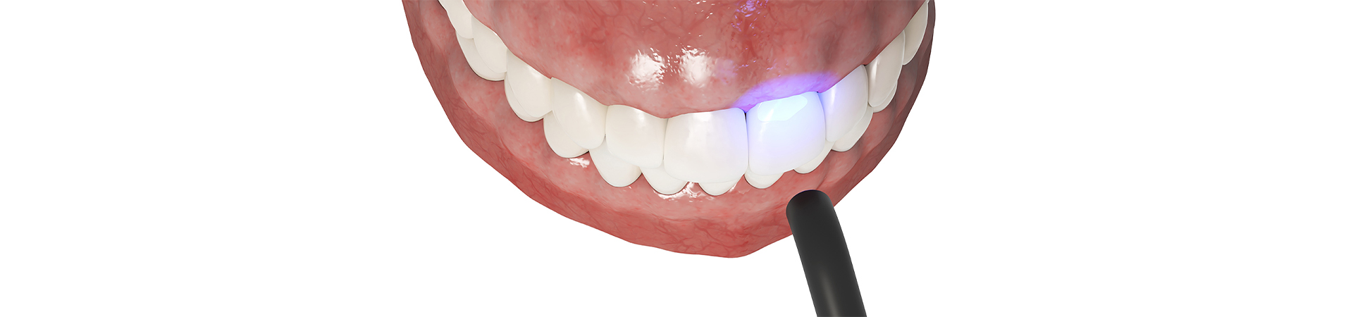 Close-up of a dentist performing dental bonding on a patient's tooth, highlighting the bonding material and tools used at New Smile Dentistry.