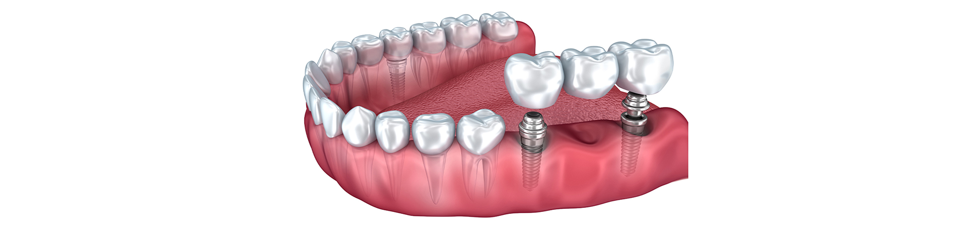 A dental bridge model displayed on a blue surface, featuring artificial teeth linked by a metal structure for dental restoration at New Smile Dentistry.