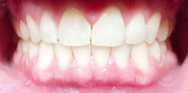A patient with a beaming smile displaying straight, white teeth, showcasing the results of dental care in a contemporary office at New Smile Dentistry.