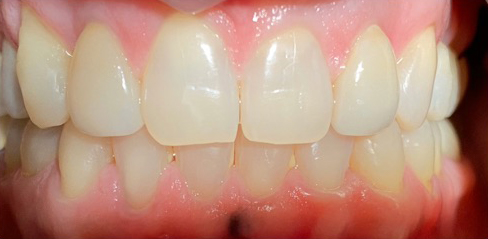 A person smiling broadly, showcasing their aligned teeth after dental treatment, with a clean and modern dental environment at New Smile Dentistry.