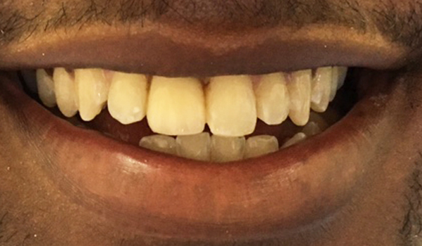 A close-up of a patient’s smile revealing straight, white teeth, highlighting the results of recent dental work at New Smile Dentistry.