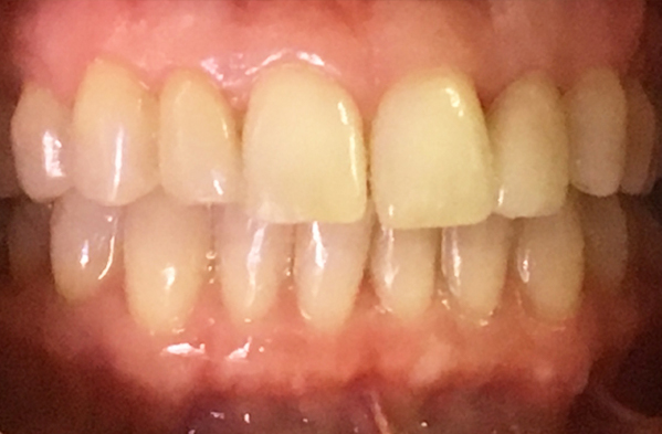 Close-up of a patient's teeth before treatment, displaying noticeable misalignment and spacing issues at New Smile Dentistry.