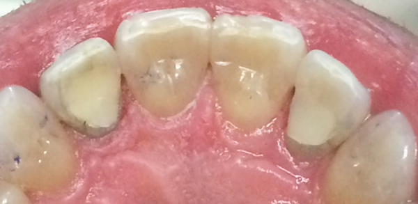 A cheerful patient with straight, white teeth smiles confidently, highlighting the success of their recent dental procedure at New Smile Dentistry.