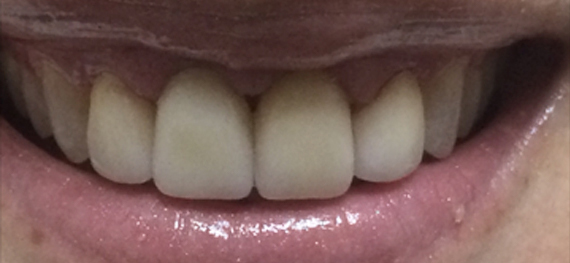 A close-up of a patient’s smile revealing straight, white teeth, highlighting the results of recent dental work at New Smile Dentistry.