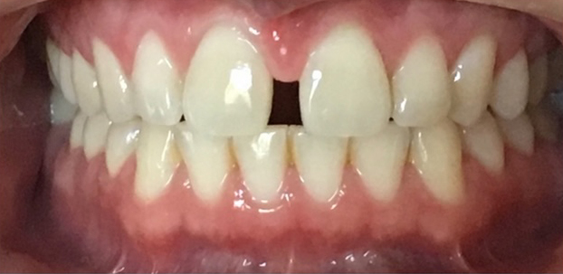 Image of a patient's smile prior to dental work, featuring crooked teeth and visible gaps at New Smile Dentistry.