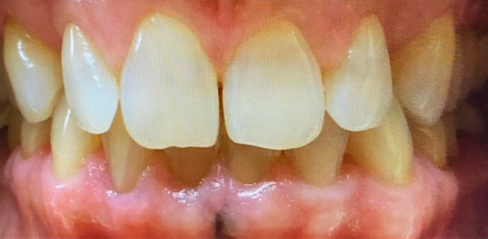 Close-up of a patient's teeth before treatment, displaying uneven alignment and significant staining at New Smile Dentistry.