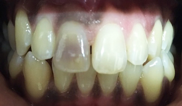 Close-up of a patient's teeth before treatment, displaying noticeable misalignment and spacing issues at New Smile Dentistry.