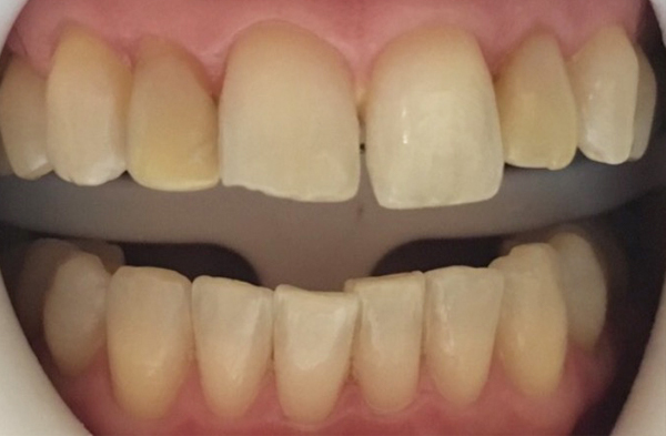 Image of a patient's smile prior to dental work, featuring crooked teeth and visible gaps at New Smile Dentistry.