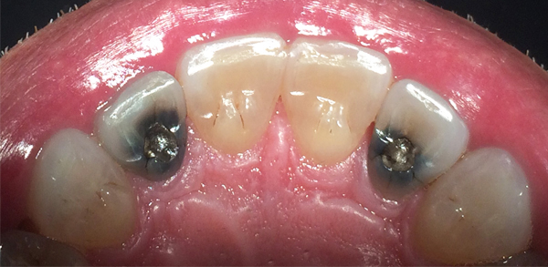 Image of a patient's teeth prior to dental work, featuring uneven alignment and visible discoloration at New Smile Dentistry.