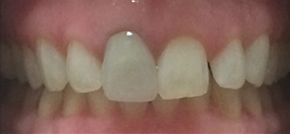 Dental before photo showing a patient's uneven and discolored teeth, indicating the need for cosmetic improvement at New Smile Dentistry.