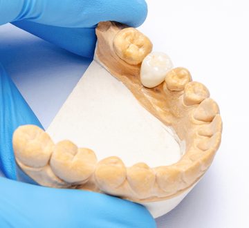 What to Do for a Loose or Dislodged Crown