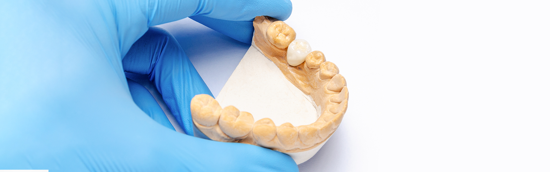 What to Do for a Loose or Dislodged Crown