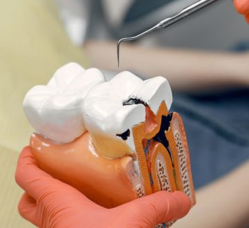 How Root Canal Treatment Saves Your Tooth and Prevents Extraction